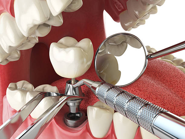 Best Emergency Tooth Extraction in Savannah, MO